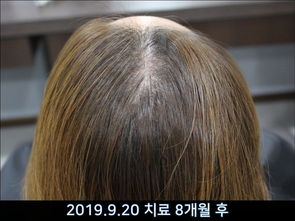 연세봄빛피부과 탈모치료 #37 (여성형탈모, 정수리탈모) 관련 이미지 3
