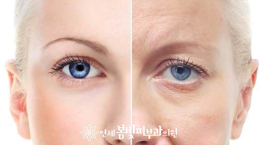 다크써클 없애는법 #4 (다크써클의 치료: 필러 시술, 필러 주사, 히알루론산 필러, 뉴라미스, 다나에, 엘라비에) 관련 이미지 4