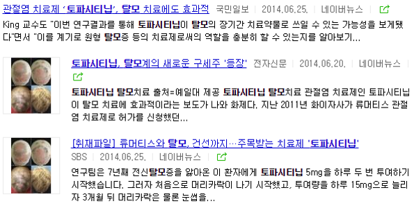 원형탈모, 머리숱많아지는법 #4 (신약-바이토린, 젤잔즈, 자가혈 PRP) 관련 이미지 4