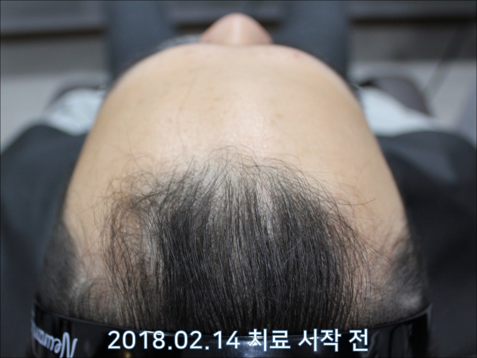 연세봄빛피부과 탈모치료 #25 (남성형탈모, 재치료, 이마탈모, 정수리탈모) 관련 이미지 6