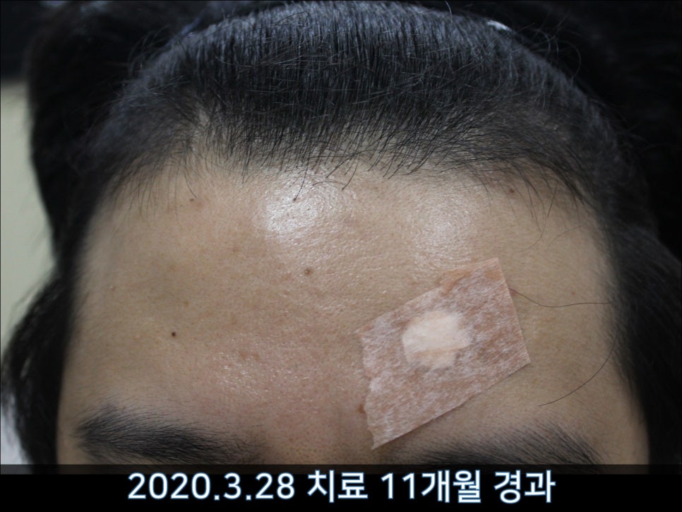 연세봄빛피부과 탈모치료 #42 (남성형탈모,M자탈모) 관련 이미지 9