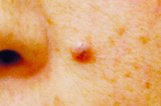 다양한 얼굴 색소 치료 #1 (점없애는법, 주근깨 없애는법) 관련 이미지 2