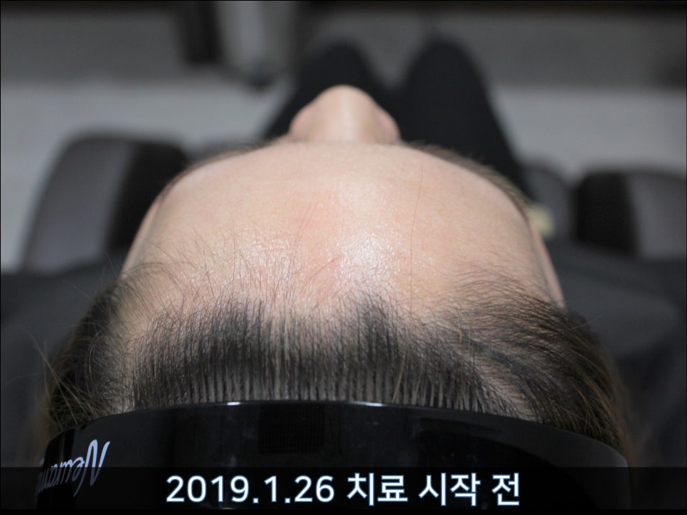 연세봄빛피부과 탈모치료 #37 (여성형탈모, 정수리탈모) 관련 이미지 4
