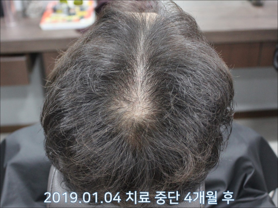 연세봄빛피부과 탈모치료 #25 (남성형탈모, 재치료, 이마탈모, 정수리탈모) 관련 이미지 3