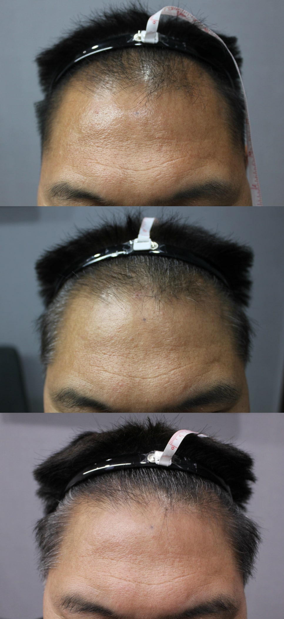 연세봄빛피부과 탈모치료 #3 (남성형탈모, 이마탈모, 정수리탈모) 관련 이미지 2