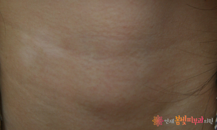 보톡스 바르게 알기 #3 (보톡스 맞고 예뻐지기, 보톡스 시술이 가능한 부위, 이마 주름, 미간 주름, 눈가 주름, 눈밑 주름, 콧잔등 주름, 입가 주름, 사각턱, 종아리, 윤곽술 관련 이미지 5