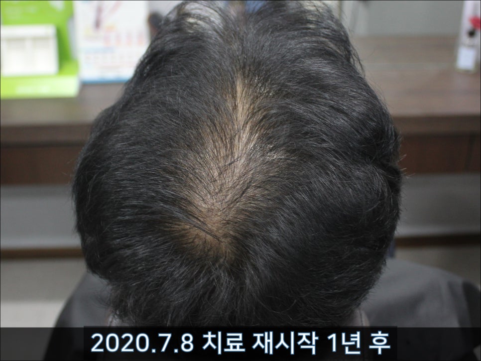 연세봄빛피부과 탈모치료 #39 (남성형탈모, 치료 중단 후 재치료) 관련 이미지 4