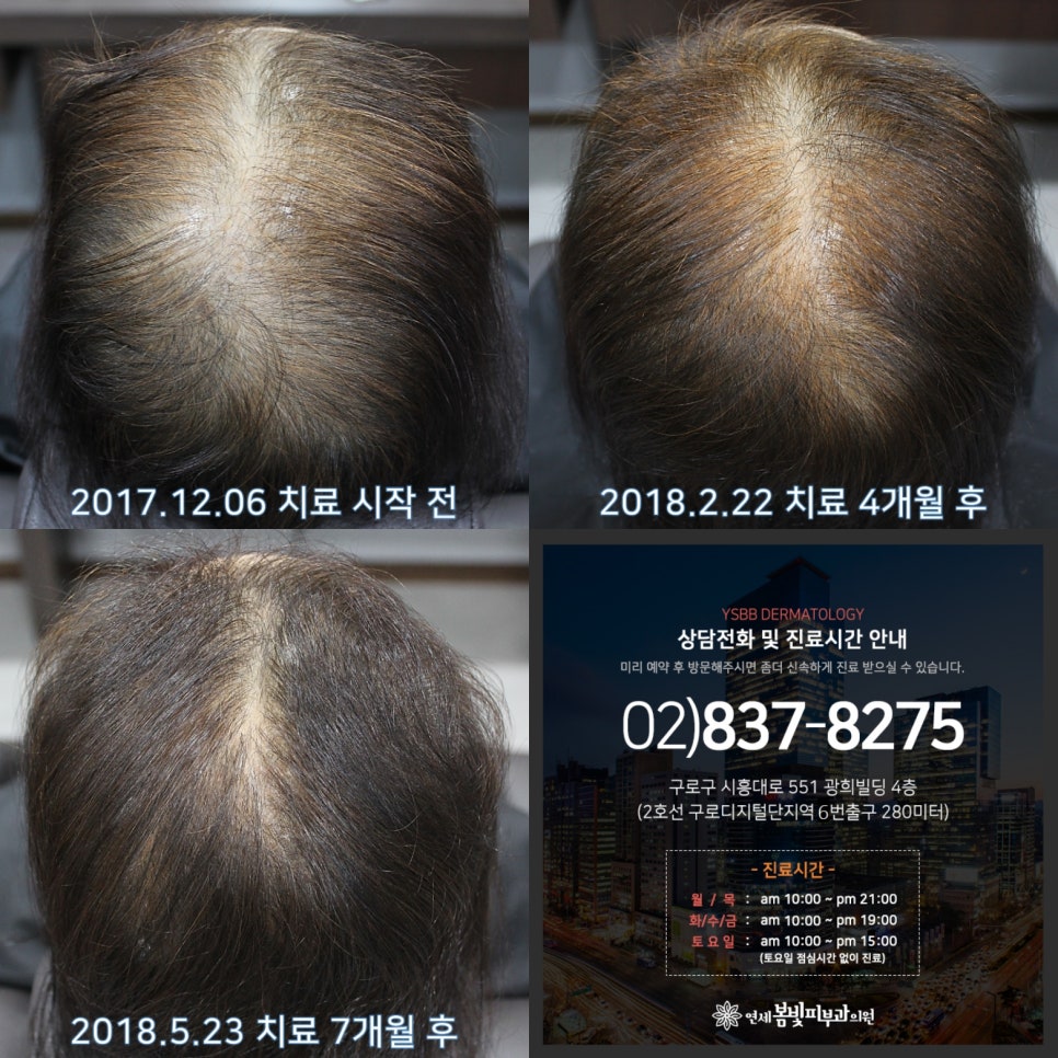 연세봄빛피부과 탈모치료 #6 (여성형탈모, 정수리탈모) 관련 이미지 7