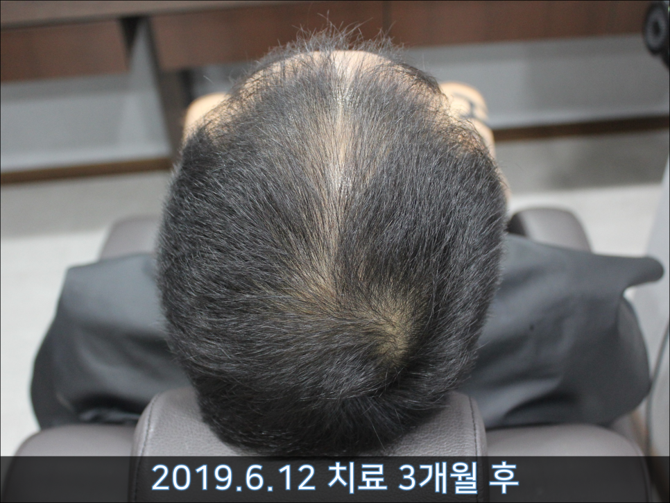 연세봄빛피부과 탈모치료 #41 (남성형탈모, 정수리탈모) 관련 이미지 2