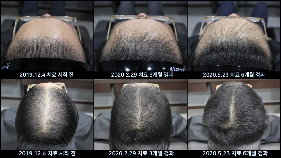 연세봄빛피부과 탈모치료 #43 (정수리탈모, F형 탈모) 관련 이미지 10