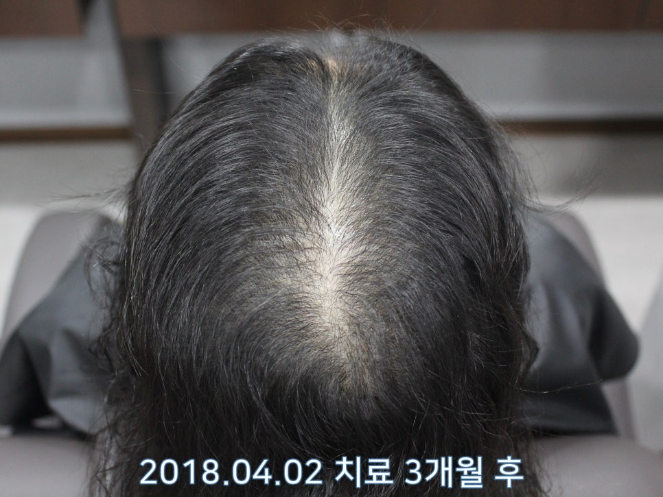 연세봄빛피부과 탈모치료 #10 (여성형탈모, 정수리탈모) 관련 이미지 3