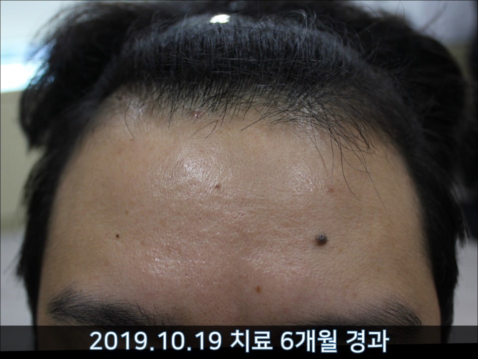 연세봄빛피부과 탈모치료 #42 (남성형탈모,M자탈모) 관련 이미지 8