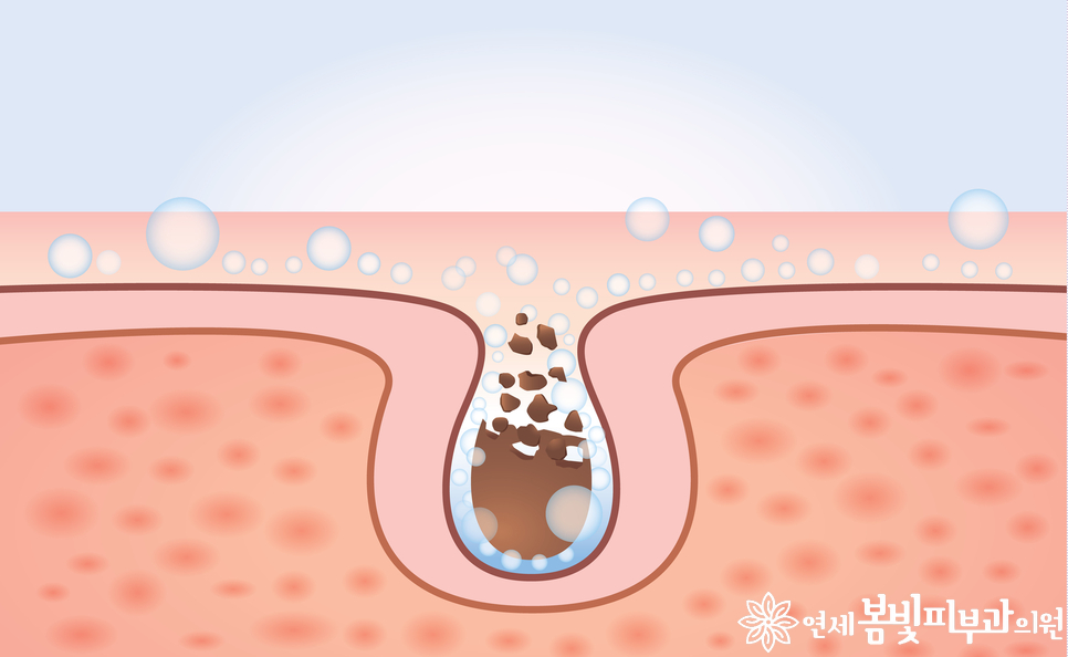 모공줄이는 방법 #1 (모공이 생기는 원인, 분류, 블랙헤드, 화이트헤드, 아쿠아필, 제네시스 레이저) 관련 이미지 7