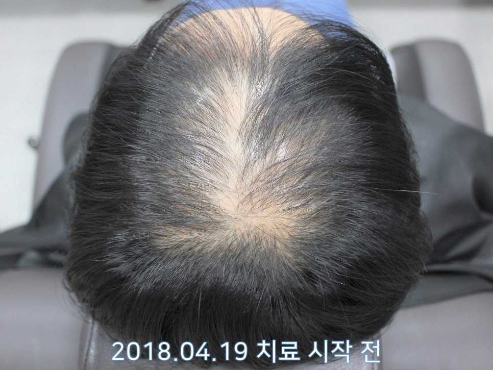 연세봄빛피부과 탈모치료 #21 (여성형탈모, 이마탈모) 관련 이미지 7