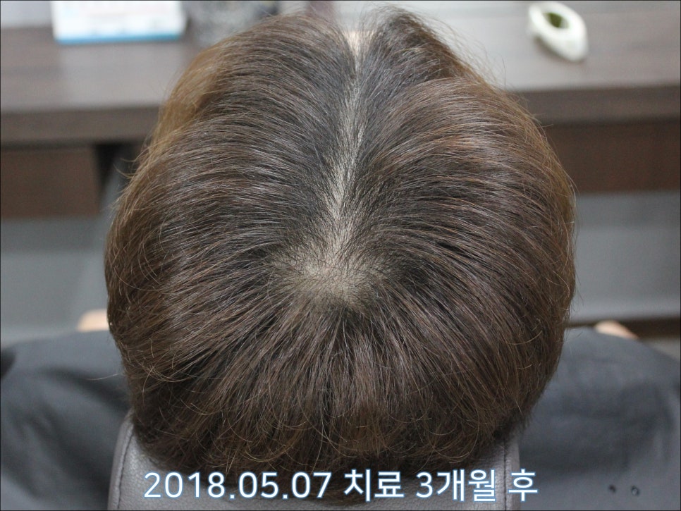 연세봄빛피부과 탈모치료 #25 (남성형탈모, 재치료, 이마탈모, 정수리탈모) 관련 이미지 2