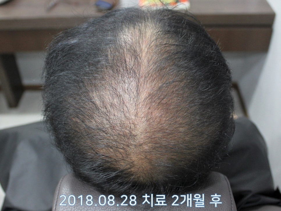 연세봄빛피부과 탈모치료 #16 (남성형탈모, 이마탈모, 정수리탈모, 3단계) 관련 이미지 2