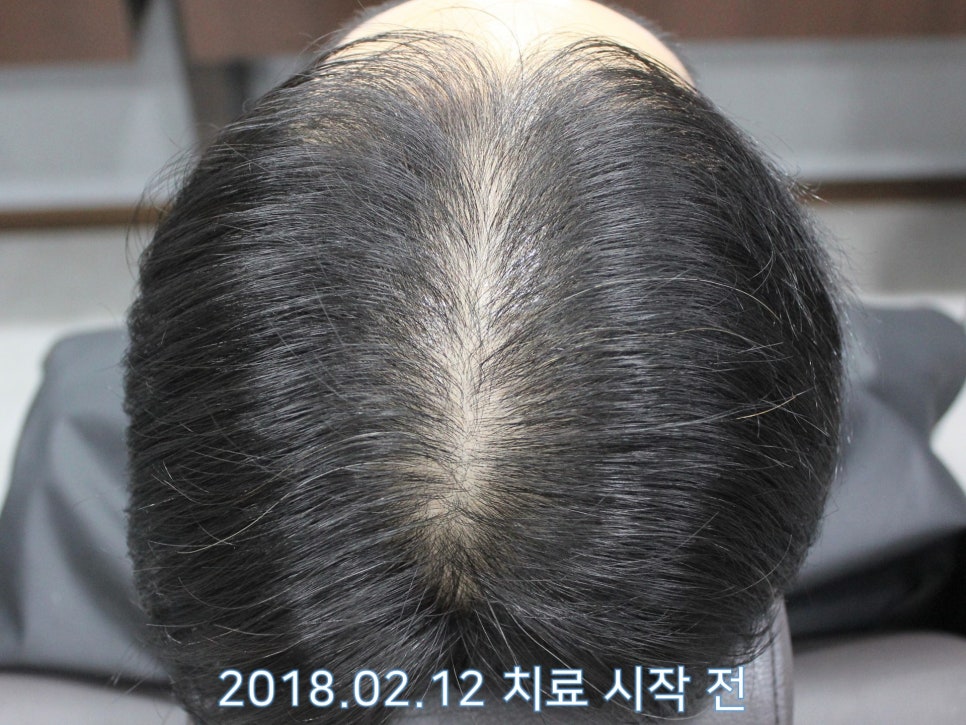 연세봄빛피부과 탈모치료 #18 (남성형탈모, 이마탈모, 정수리탈모, 모발이식 후 치료) 관련 이미지 5
