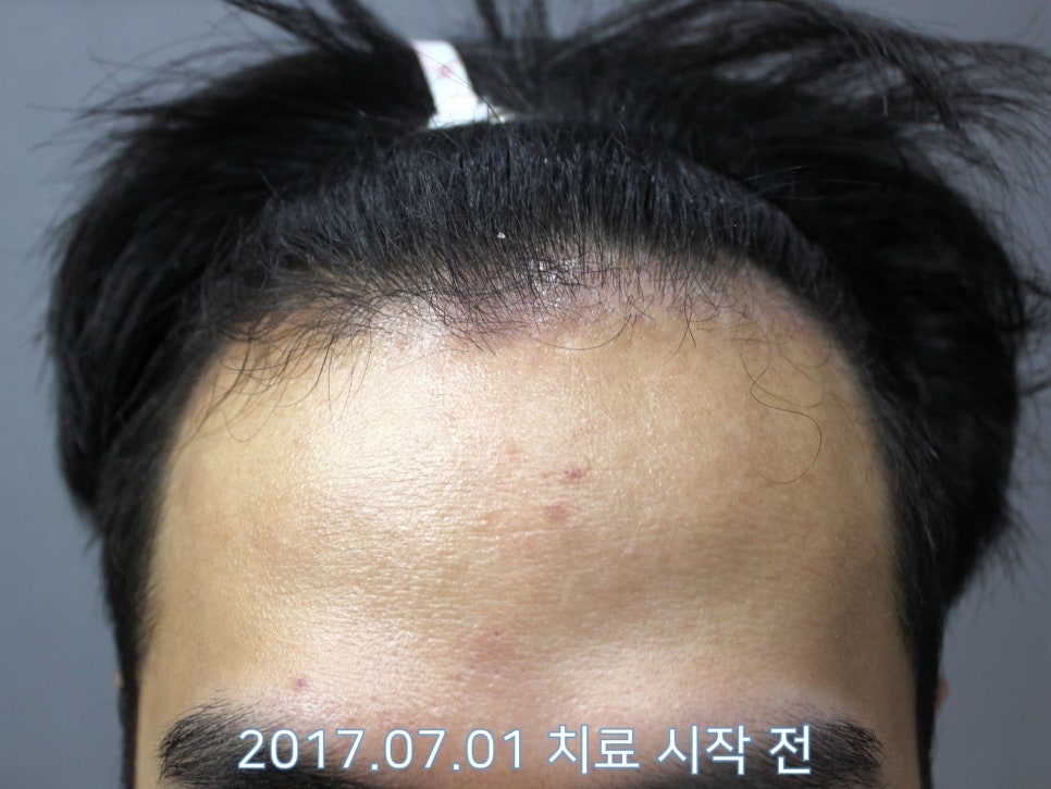 연세봄빛피부과 탈모치료 #14 (남성형탈모, 이마탈모) 관련 이미지 1