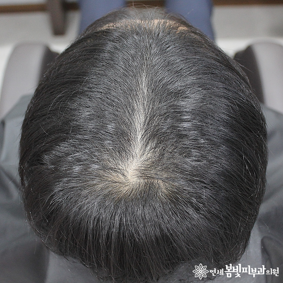 연세봄빛피부과 탈모치료 #2 (남성형탈모, 이마탈모, 정수리탈모) 관련 이미지 3
