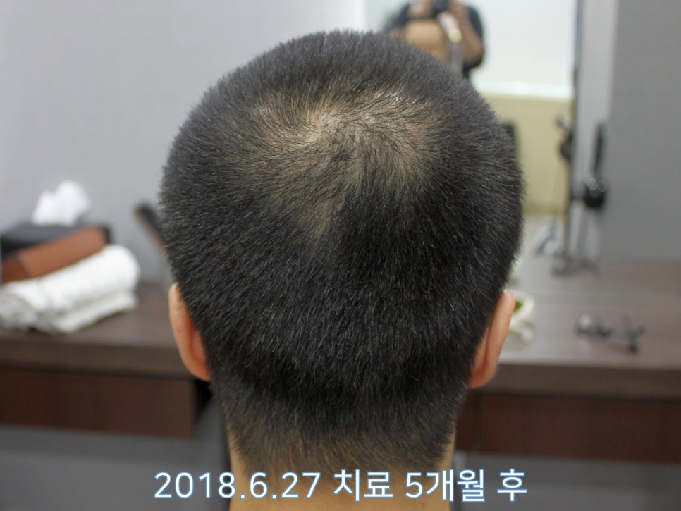 연세봄빛피부과 탈모치료 #17 (남성형탈모, 정수리탈모, F유형) 관련 이미지 7
