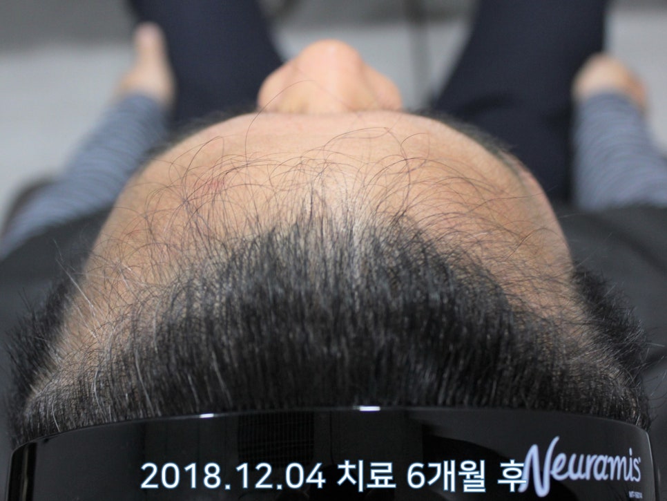 연세봄빛피부과 탈모치료 #16 (남성형탈모, 이마탈모, 정수리탈모, 3단계) 관련 이미지 9