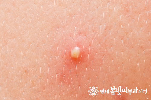 여드름 패치 안전하게 사용하기 관련 이미지 5