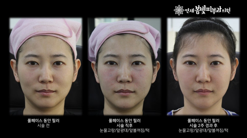 동안필러 치료 예시 #5 관련 이미지 4