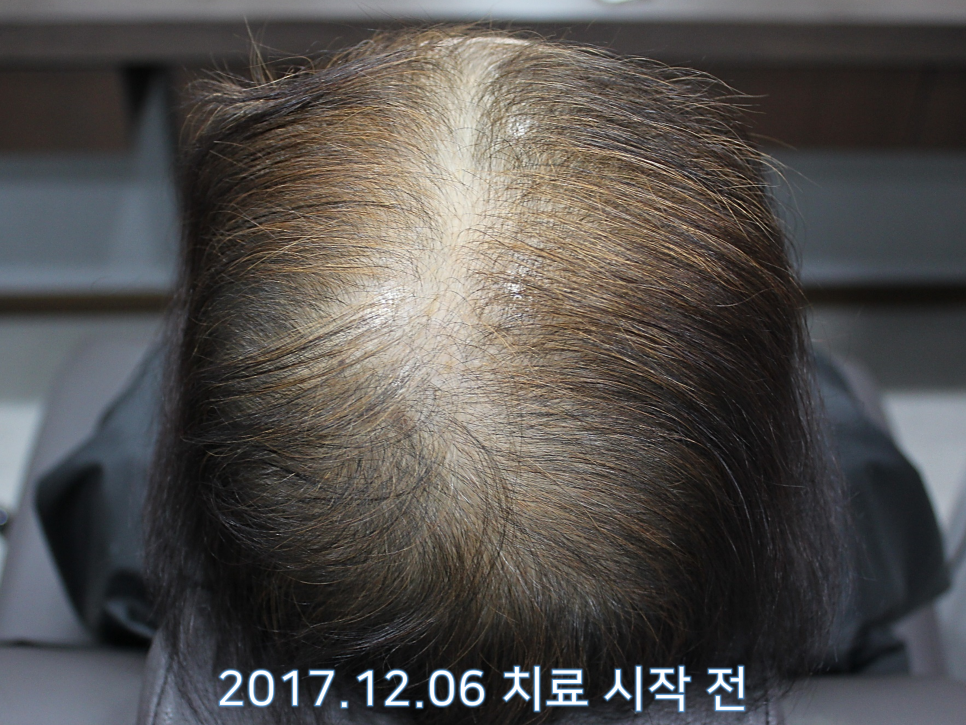 연세봄빛피부과 탈모치료 #6 (여성형탈모, 정수리탈모) 관련 이미지 1