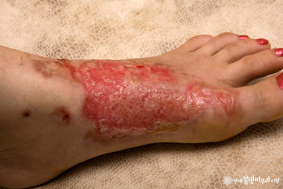 화상, 화상치료, 화상흉터치료 잘 하는 법 (화상병원, 화상피부과) 관련 이미지 4