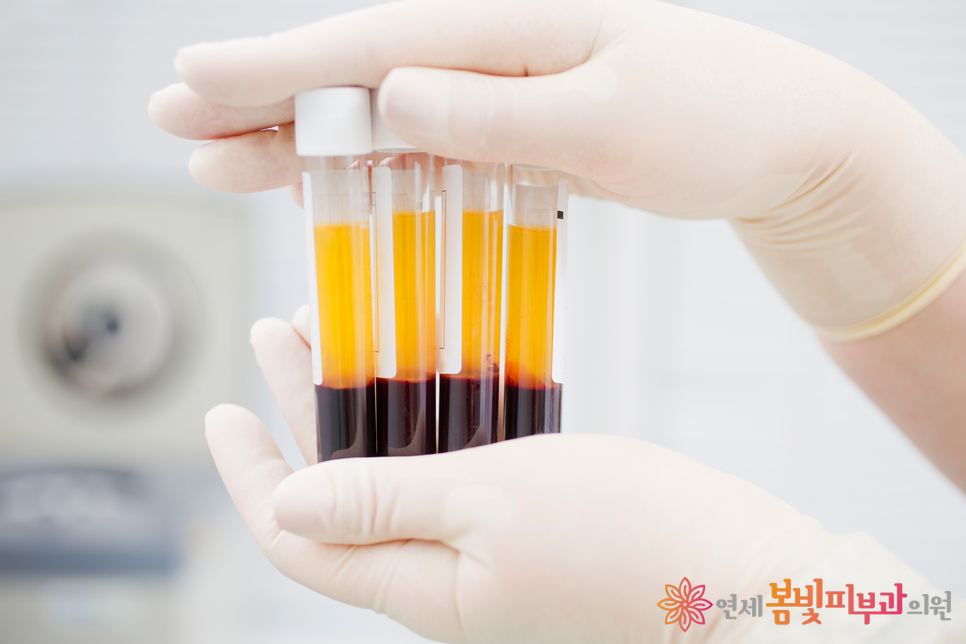 다크써클 없애는법 #5 (다크써클의 치료: 기타 주사 치료, PDRN, 리쥬란 힐러, 플라센텍스, 혈소판 풍부 인자, PRP) 관련 이미지 3