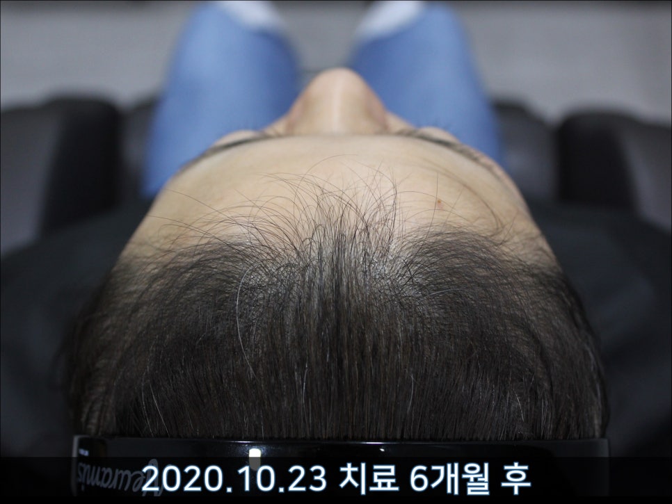 연세봄빛피부과 탈모치료 #45 (AI를 이용한 탈모 치료 성과 분석) 관련 이미지 7