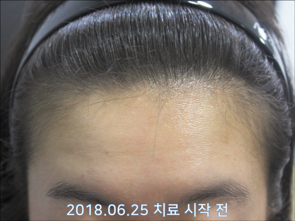 연세봄빛피부과 탈모치료 #24 (여성형 탈모, 이마탈모, 정수리탈모) 관련 이미지 2