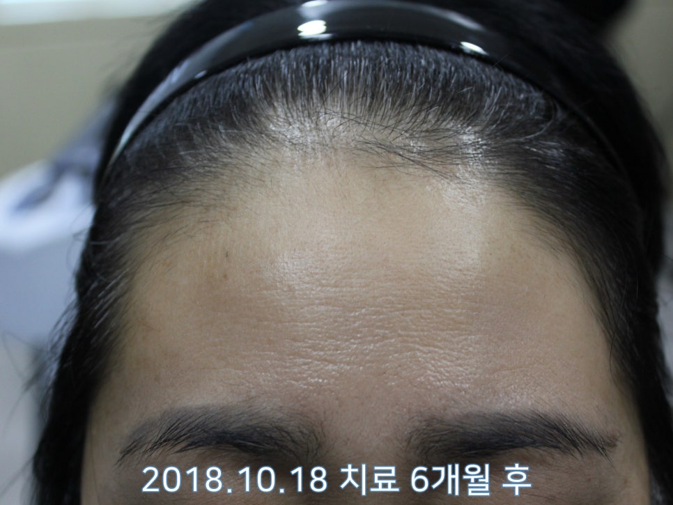 연세봄빛피부과 탈모치료 #21 (여성형탈모, 이마탈모) 관련 이미지 5