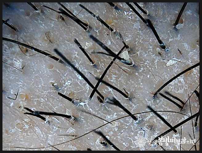 머리뽑는습관으로 생기는 탈모, 발모벽 관련 이미지 4