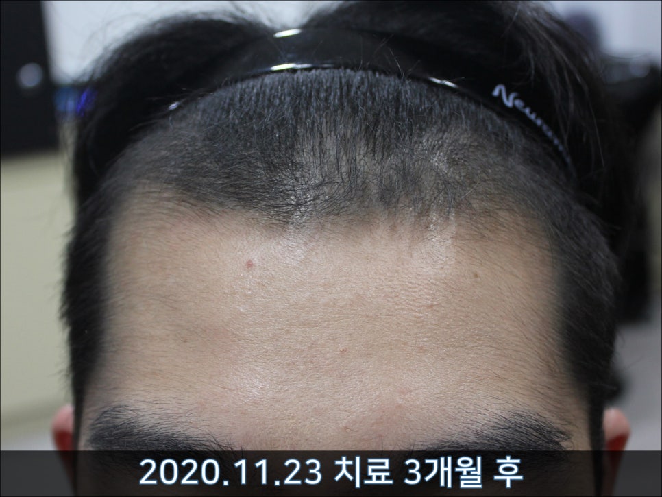 연세봄빛피부과 탈모치료 #32 (남성형탈모, 이마탈모, 정수리탈모, 두피보톡스) 관련 이미지 2