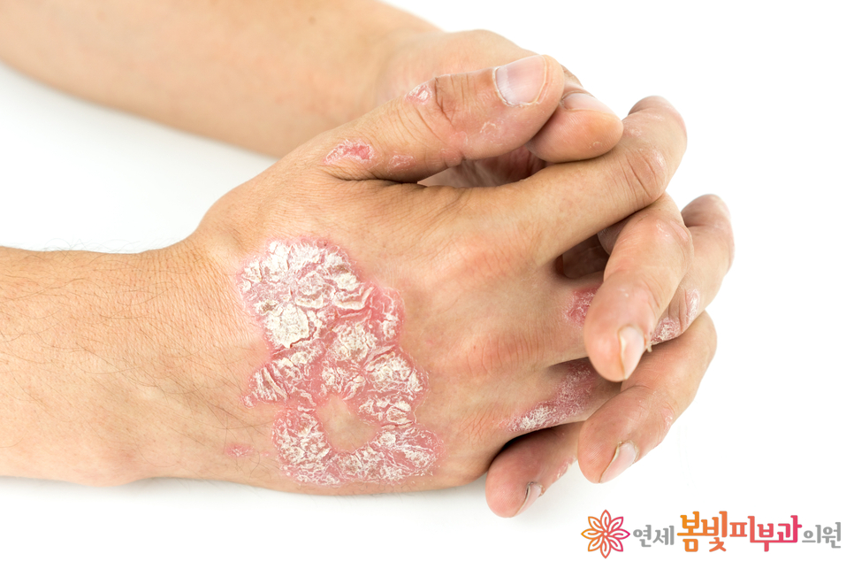 건선 이야기 #1 (건선이란?, 건선 바르게 이해 하기, 건선의 종류) 관련 이미지 5