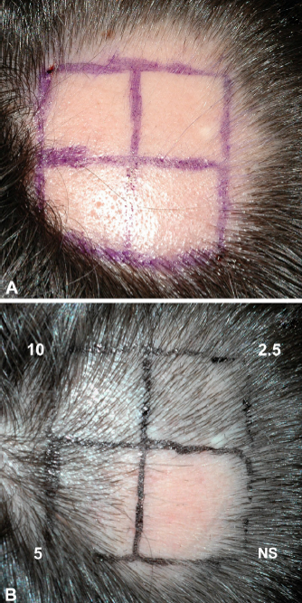 원형탈모, 머리숱많아지는법 #2 (트리암시놀론 주사 탈모치료) 관련 이미지 2
