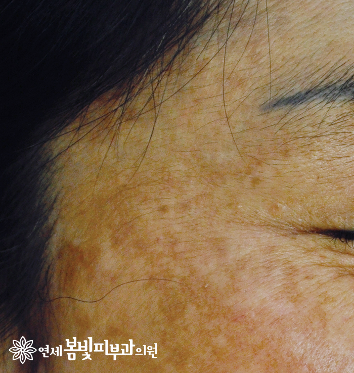 다양한 얼굴 색소 치료 #3 (오타모반, 오타모양반점) 관련 이미지 1