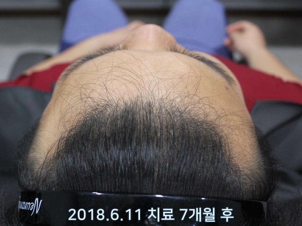 연세봄빛피부과 탈모치료 #11 (남성형탈모, 이마탈모, 정수리탈모) 관련 이미지 3