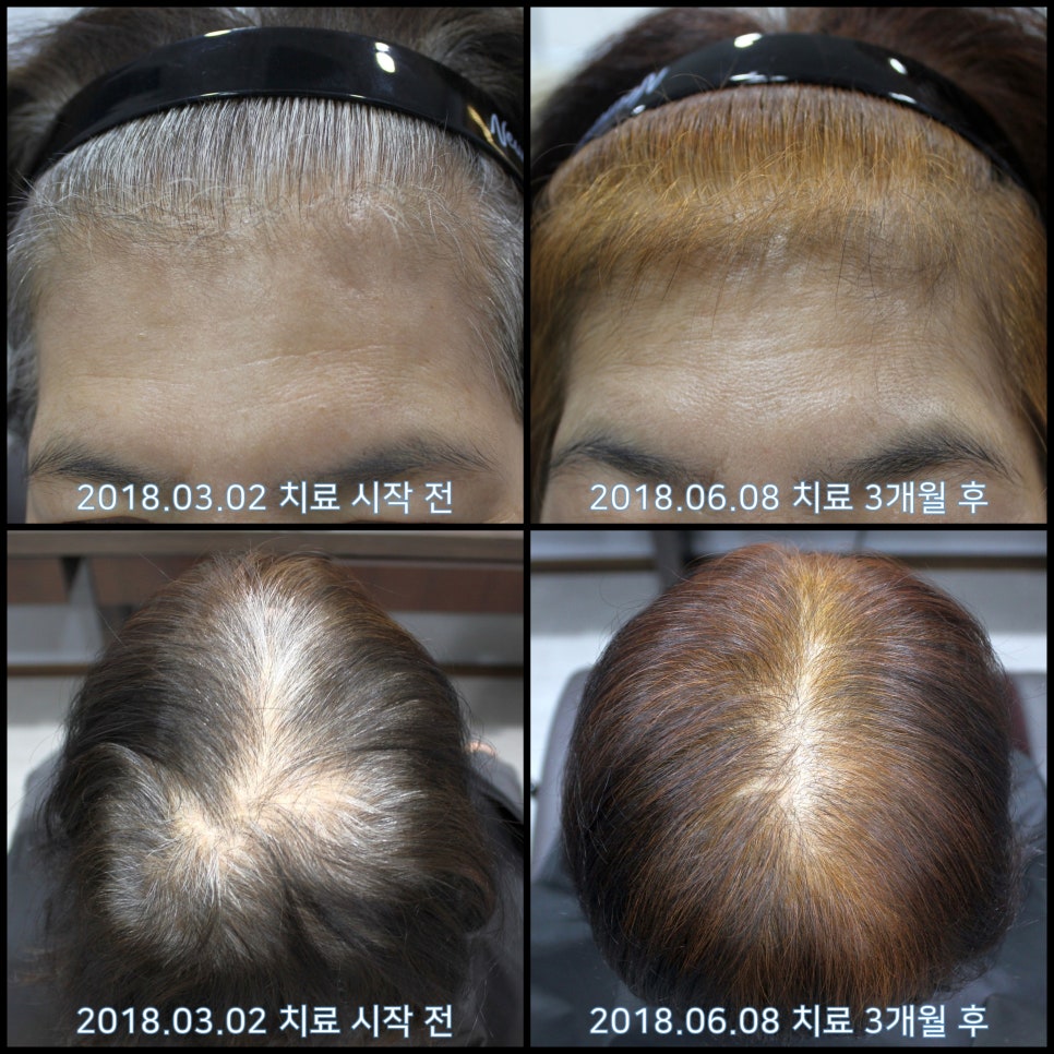 연세봄빛피부과 탈모치료 #19 (여성형탈모, 이마탈모, 정수리탈모, 부분가발) 관련 이미지 5
