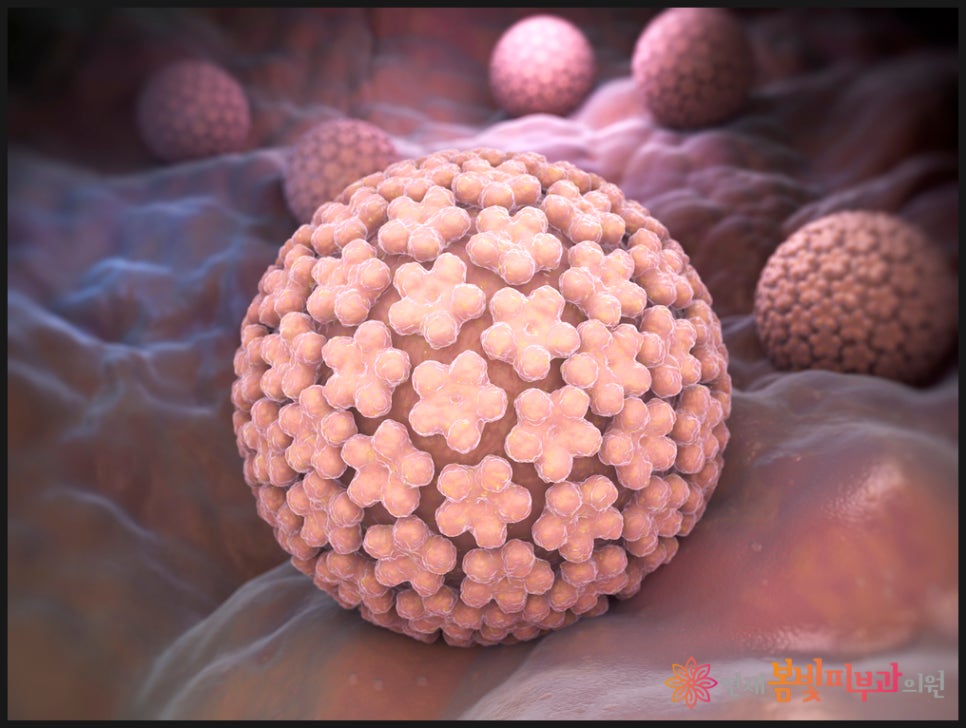 바이러스성 사마귀는 왜 자꾸 생길까요? (보통 사마귀, 편평 사마귀, 손발바닥 사마귀, 냉동치료,  블레오마이신 주사 치료, 레이저 치료) 관련 이미지 1
