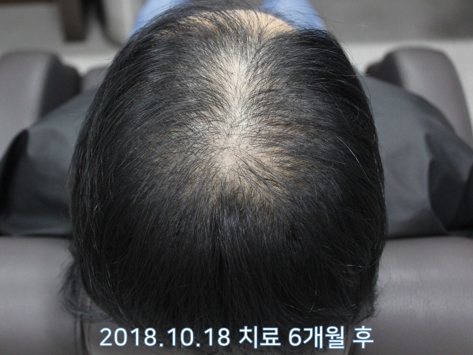 연세봄빛피부과 탈모치료 #21 (여성형탈모, 이마탈모) 관련 이미지 9