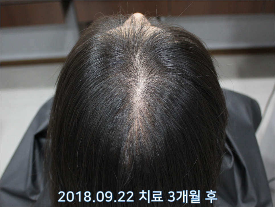 연세봄빛피부과 탈모치료 #24 (여성형 탈모, 이마탈모, 정수리탈모) 관련 이미지 7