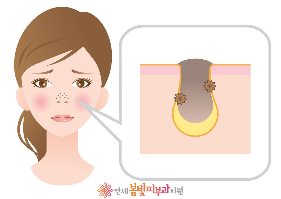 모공줄이는 방법 #1 (모공이 생기는 원인, 분류, 블랙헤드, 화이트헤드, 아쿠아필, 제네시스 레이저) 관련 이미지 1