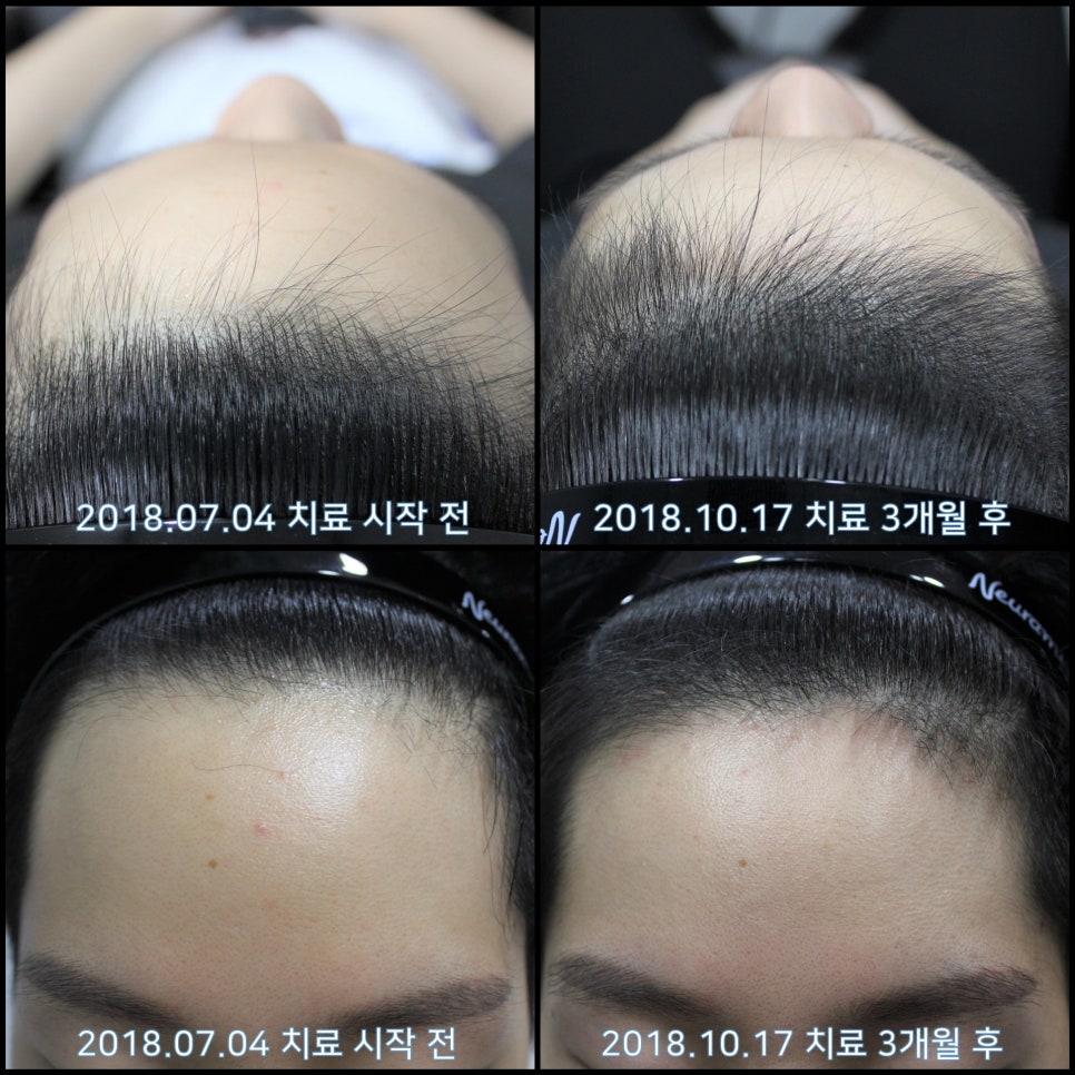 연세봄빛피부과 탈모치료 #26 (남성형탈모, 이마탈모) 관련 이미지 5