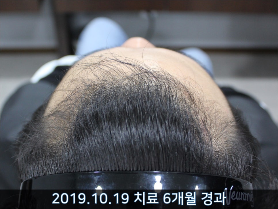 연세봄빛피부과 탈모치료 #42 (남성형탈모,M자탈모) 관련 이미지 4