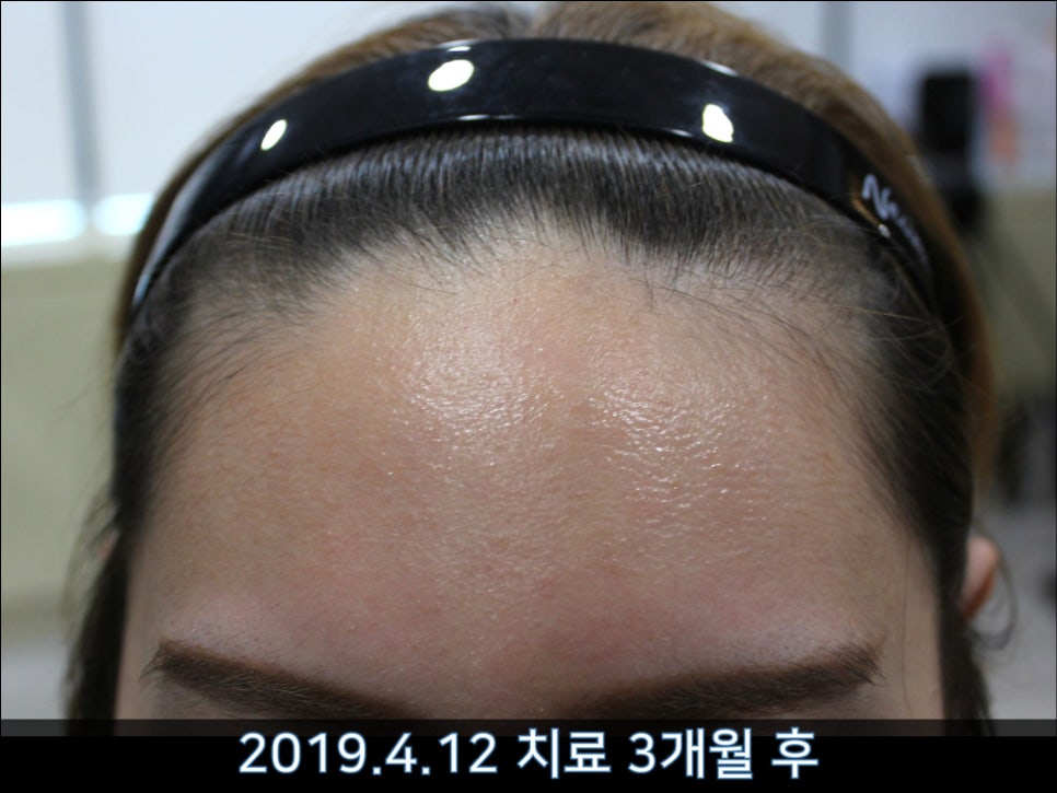연세봄빛피부과 탈모치료 #37 (여성형탈모, 정수리탈모) 관련 이미지 8