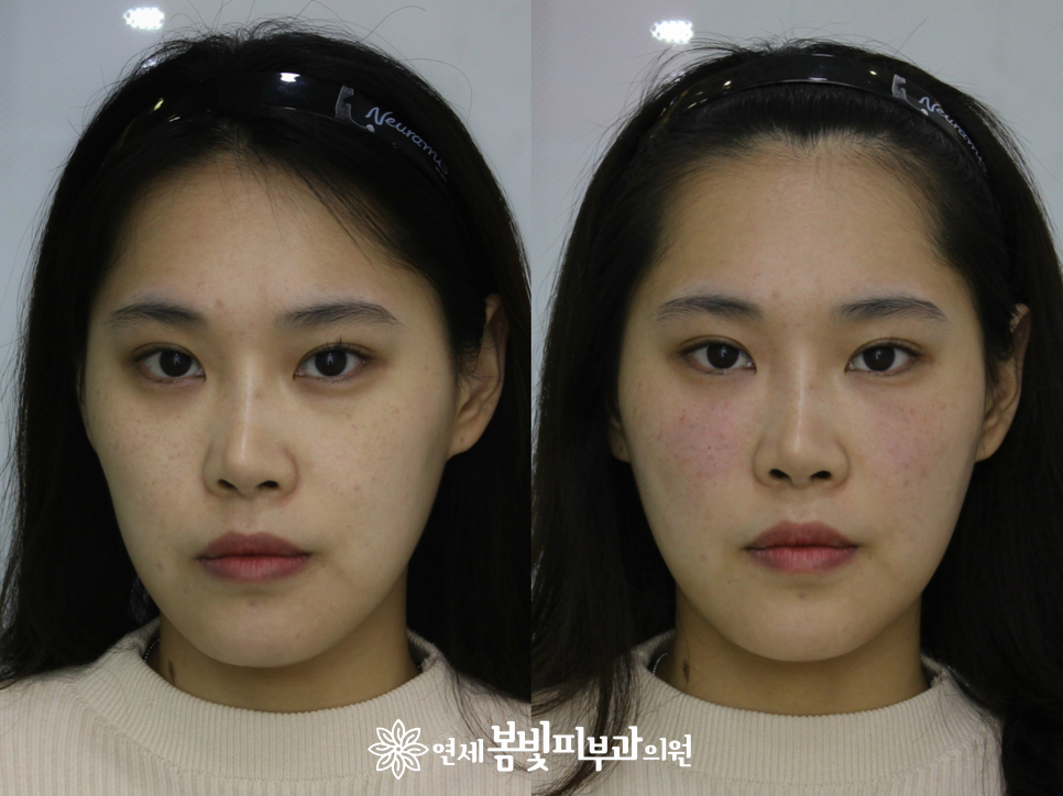 동안필러 치료 예시 #1,2 (앞광대필러, 눈물도랑필러, 볼꺼짐필러) 관련 이미지 4
