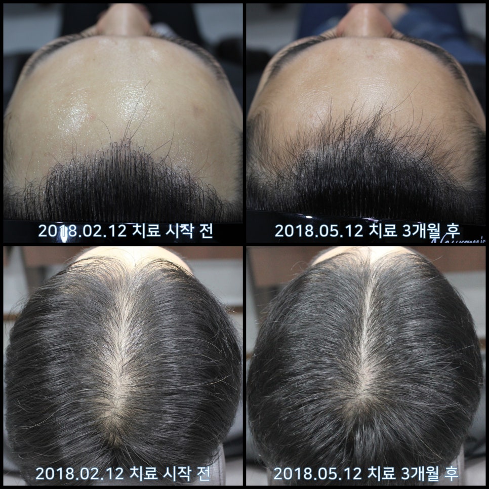 연세봄빛피부과 탈모치료 #18 (남성형탈모, 이마탈모, 정수리탈모, 모발이식 후 치료) 관련 이미지 8