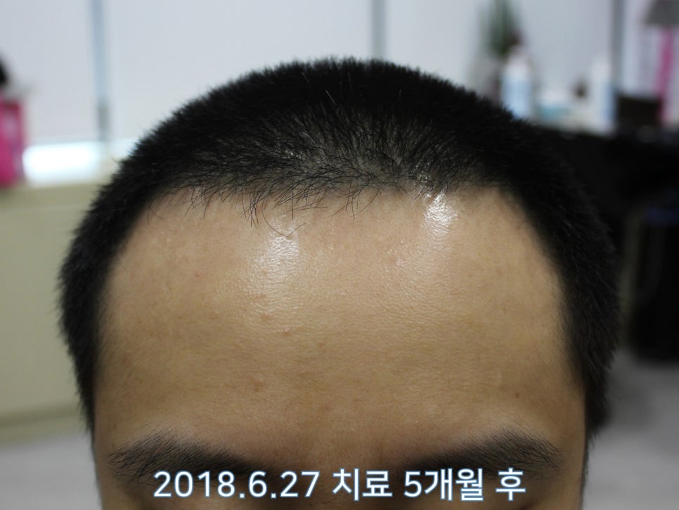연세봄빛피부과 탈모치료 #17 (남성형탈모, 정수리탈모, F유형) 관련 이미지 4